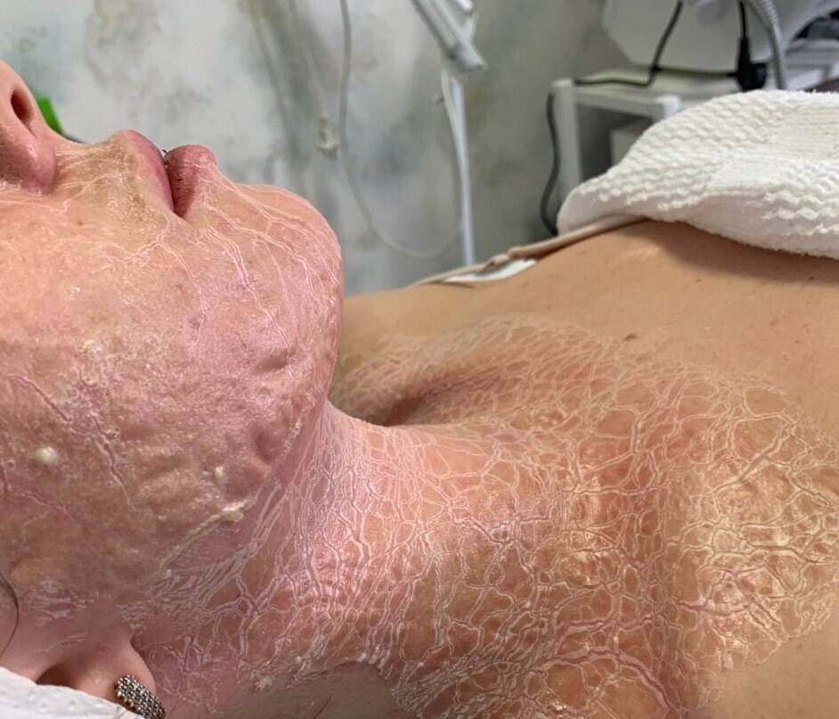 Пілінг обличчя ДМК у Львові