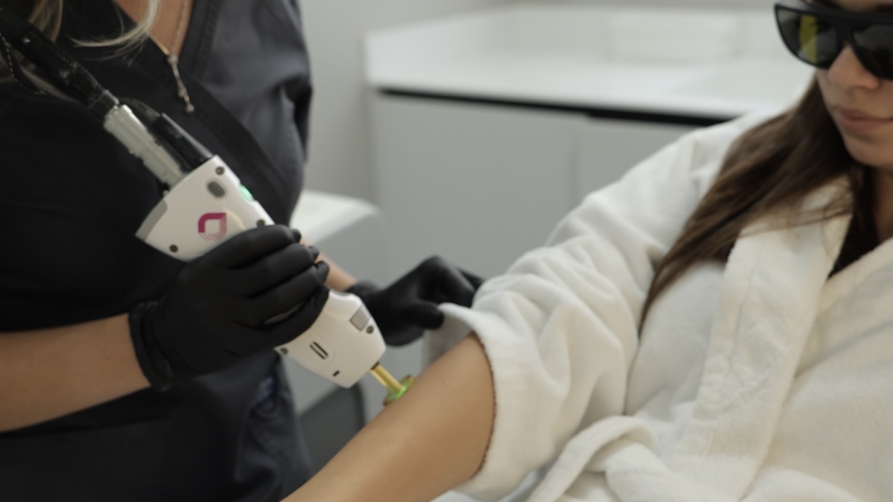 Лазерна епіляція