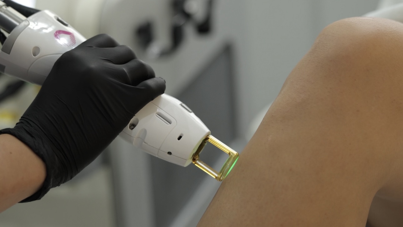 Лазерна епіляція