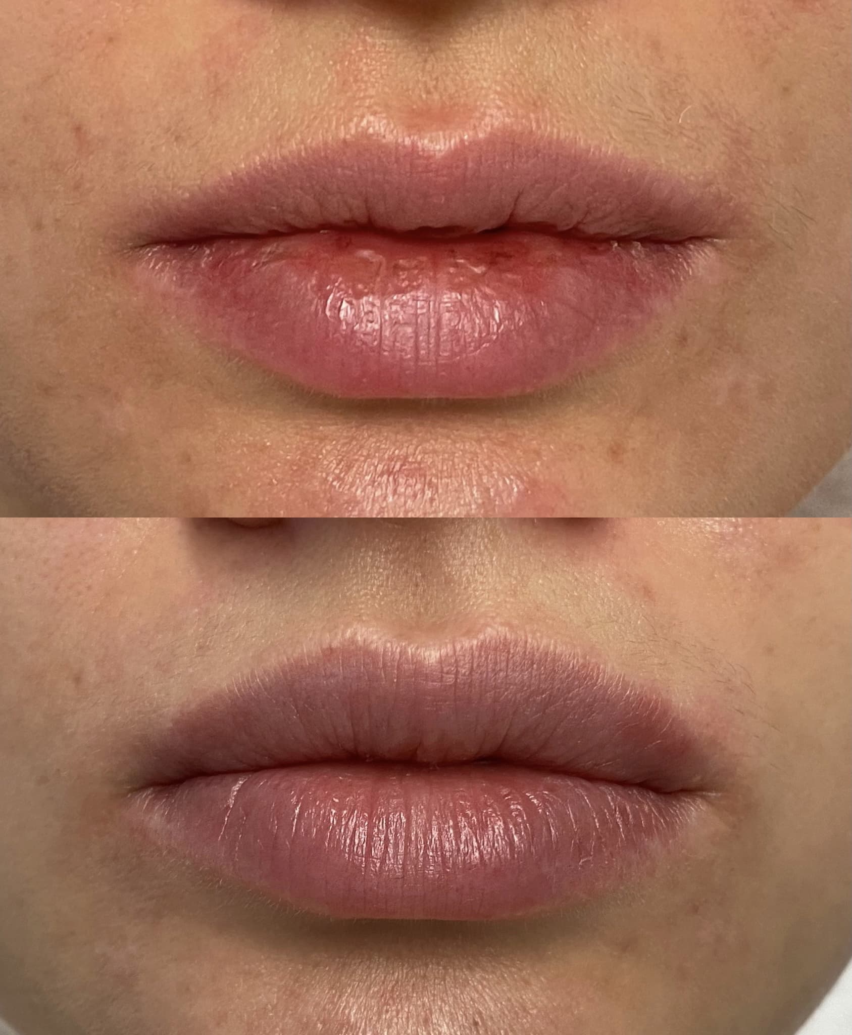 Збільшення губ (фото до та після)