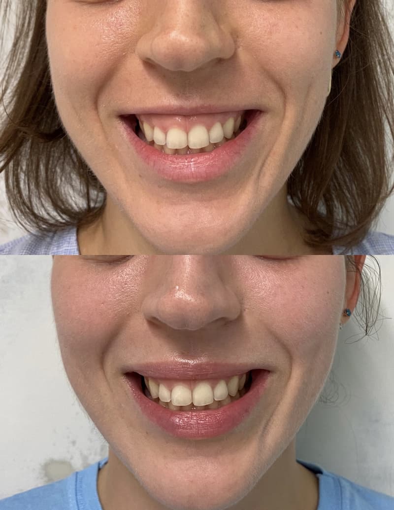 Збільшення губ (фото до та після)