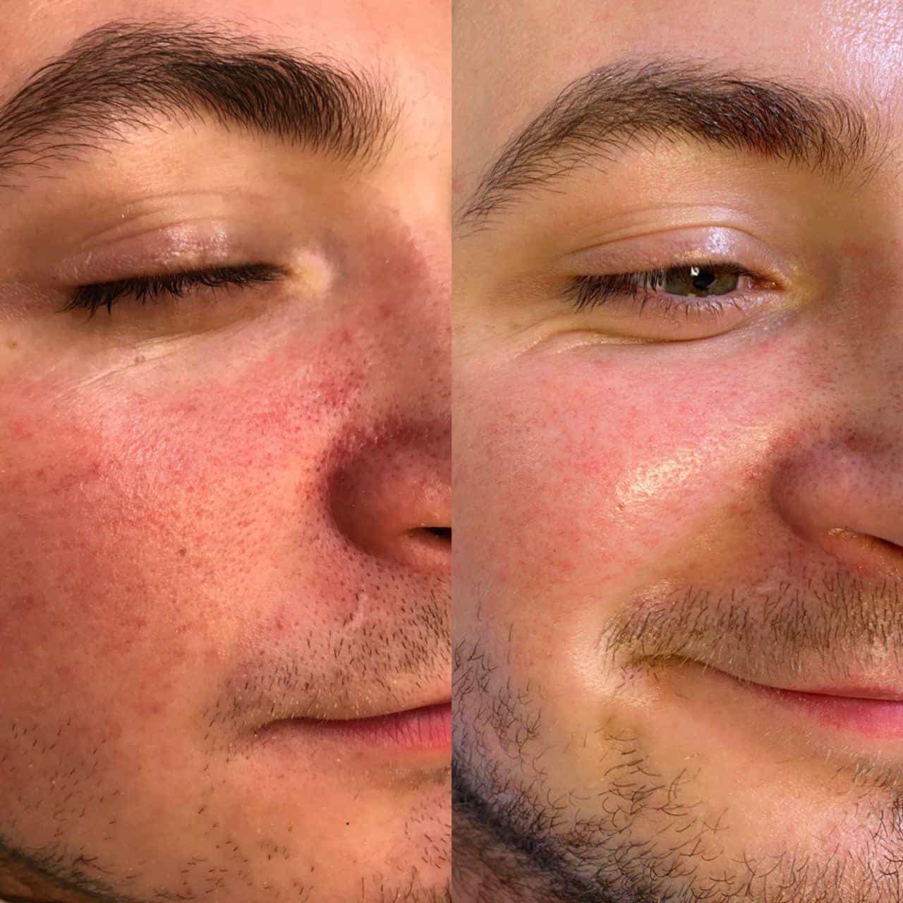 Лікування розацеа, фото до та після