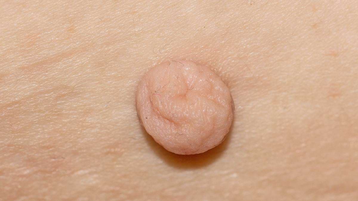 Видалення папілом у Львові