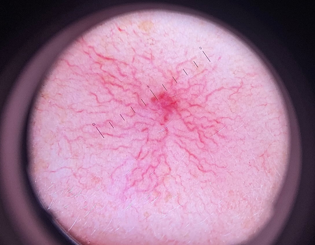 Лазерне видалення судин