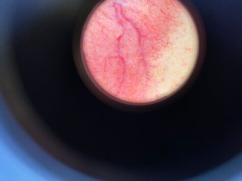 Судинна зірочка