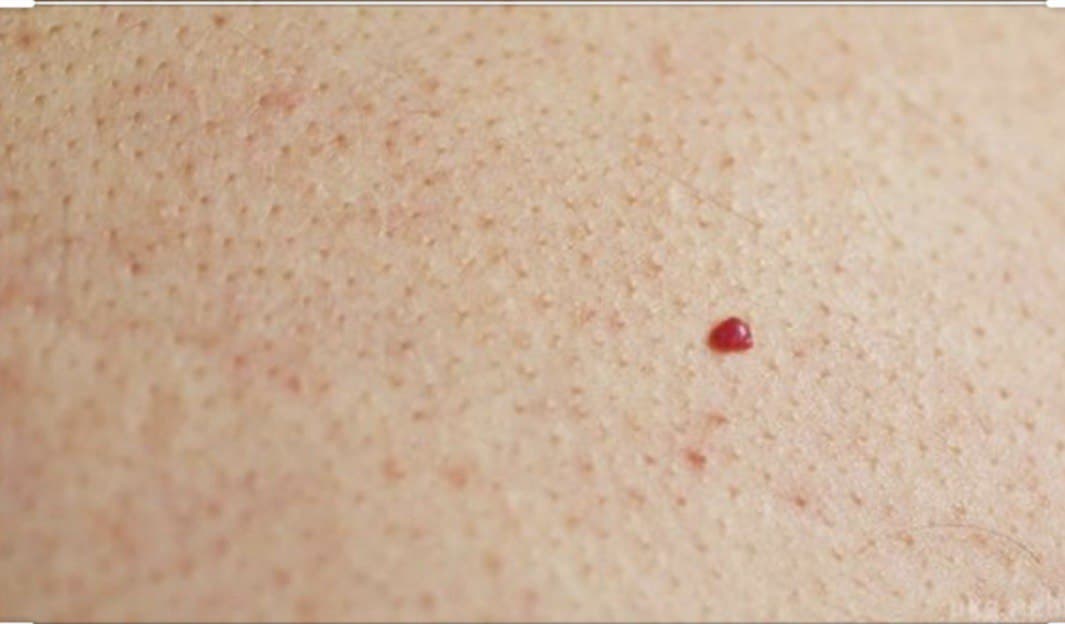 Судинні новоутвори