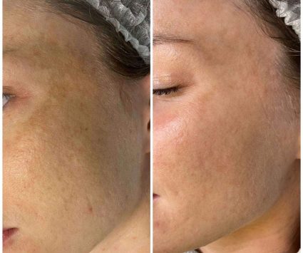 Лікування гіперпігментації фото до та після