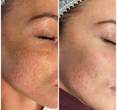 Лікування гіперпігментації фото до та після