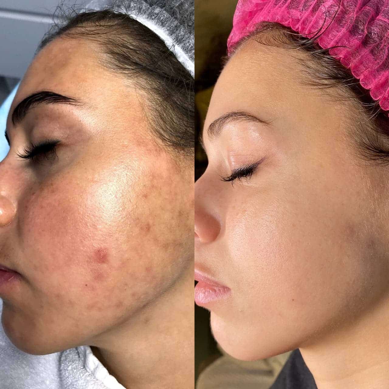 лікування гіперпігментації