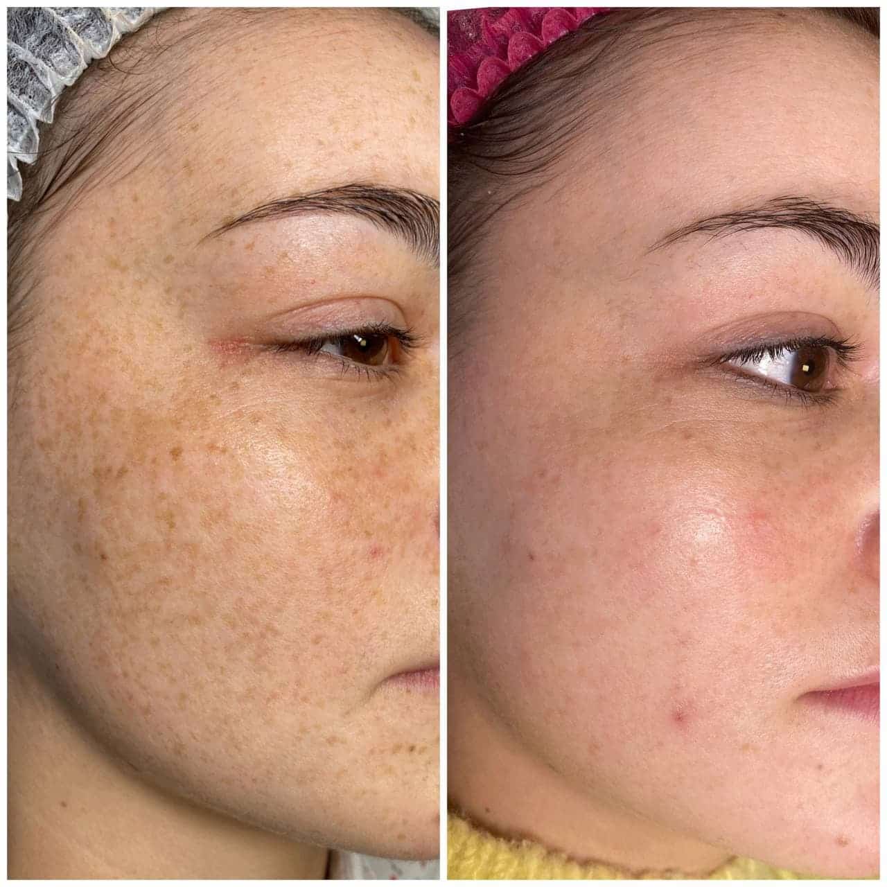 лікування гіперпігментації фототерапією IPL