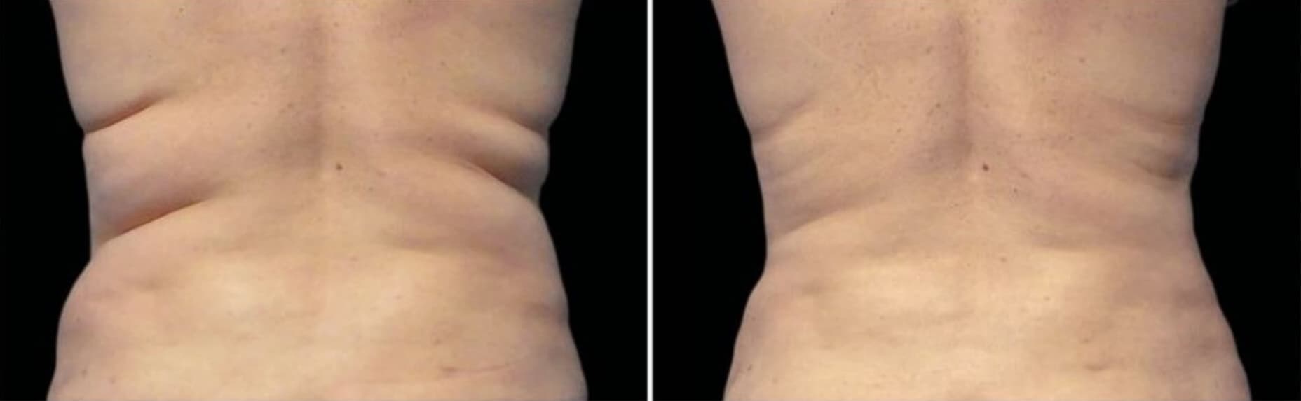 Кріоліполіз, результати до та після