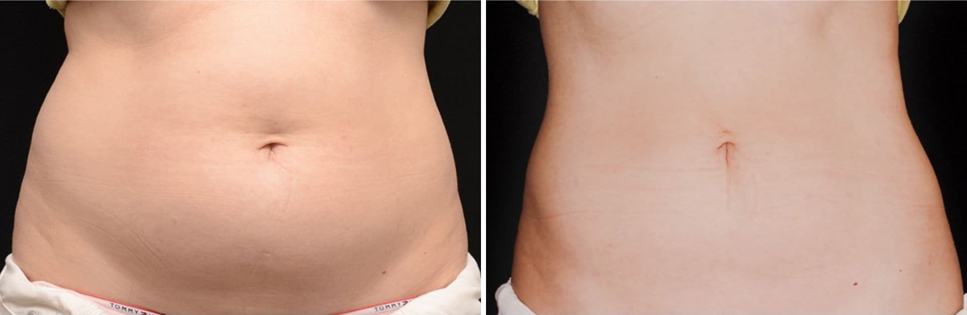 Кріоліполіз, результати до та після