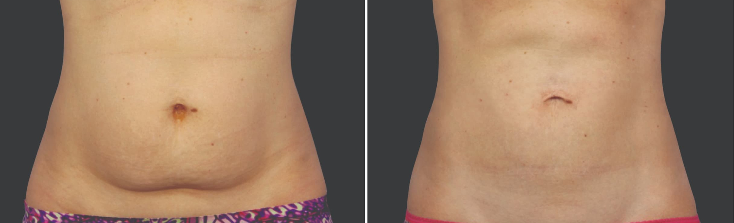 Результат кріоліполізу