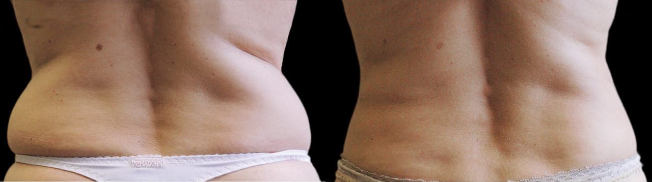 Кріоліполіз, результати до та після