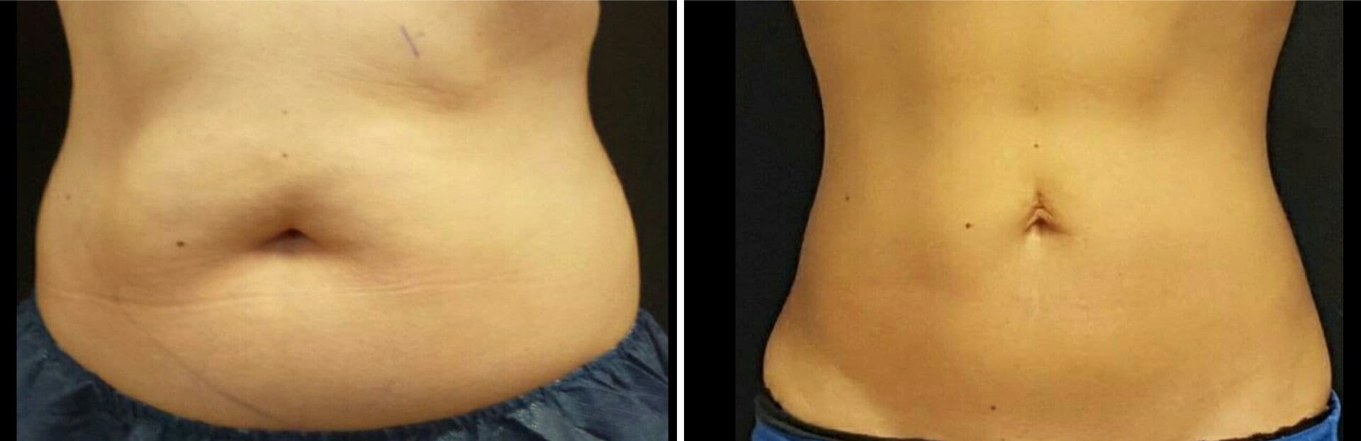 Кріоліполіз, результати до та після