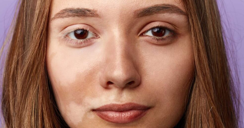 Порушення пігментації.