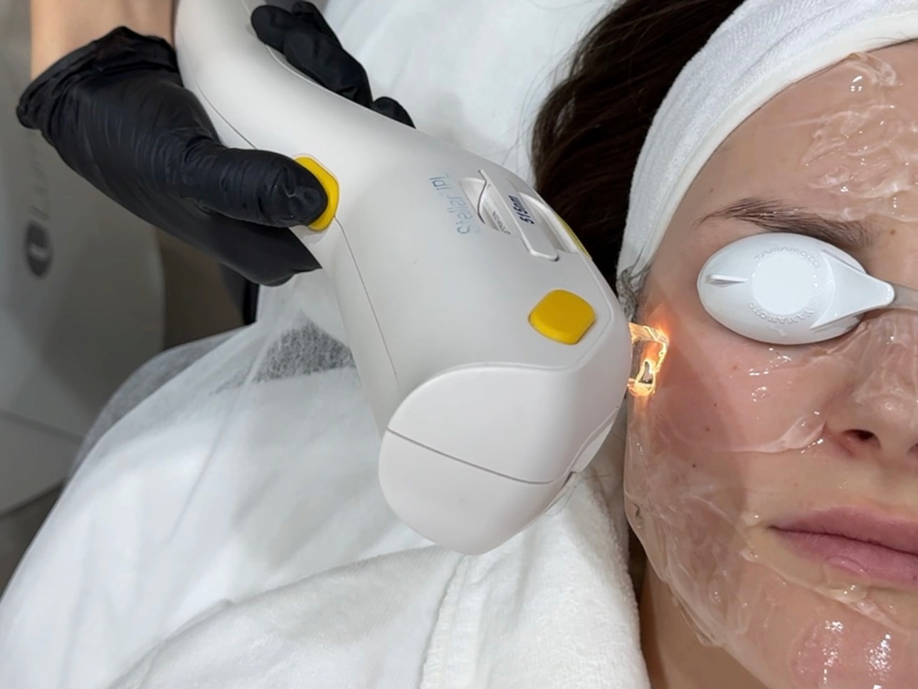 Лазерне видалення пігментних плям